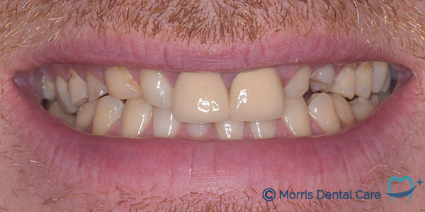 Before treatment the patient had crowded teeth which inhibited good oral care (teeth cleaning)